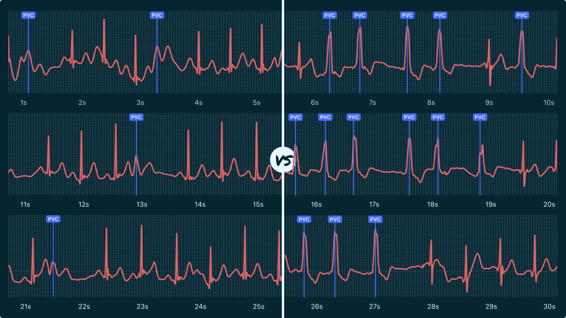Premature Ventricular Contraction (Multiple) Vs. Ventricular
